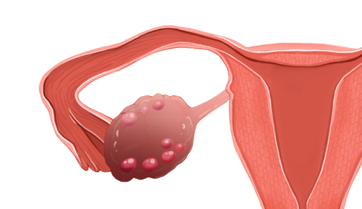 다낭성 난소증후군