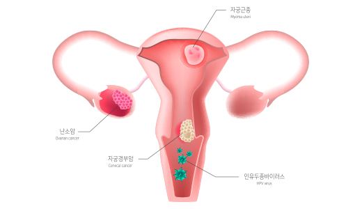 자궁 질환