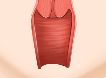 질 필러 주입 전