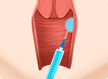 질 필러 주입 중