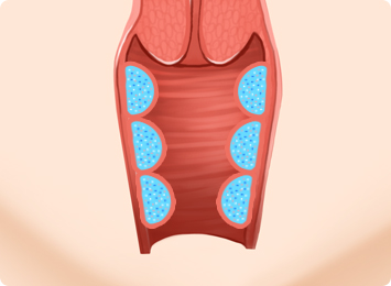 질 필러 주입 완료